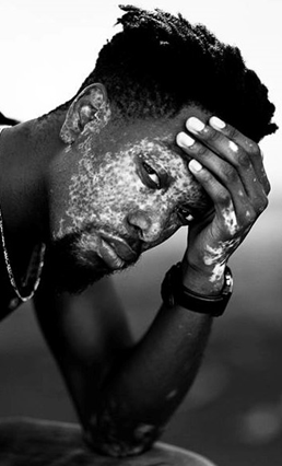 vitiligo vipoc