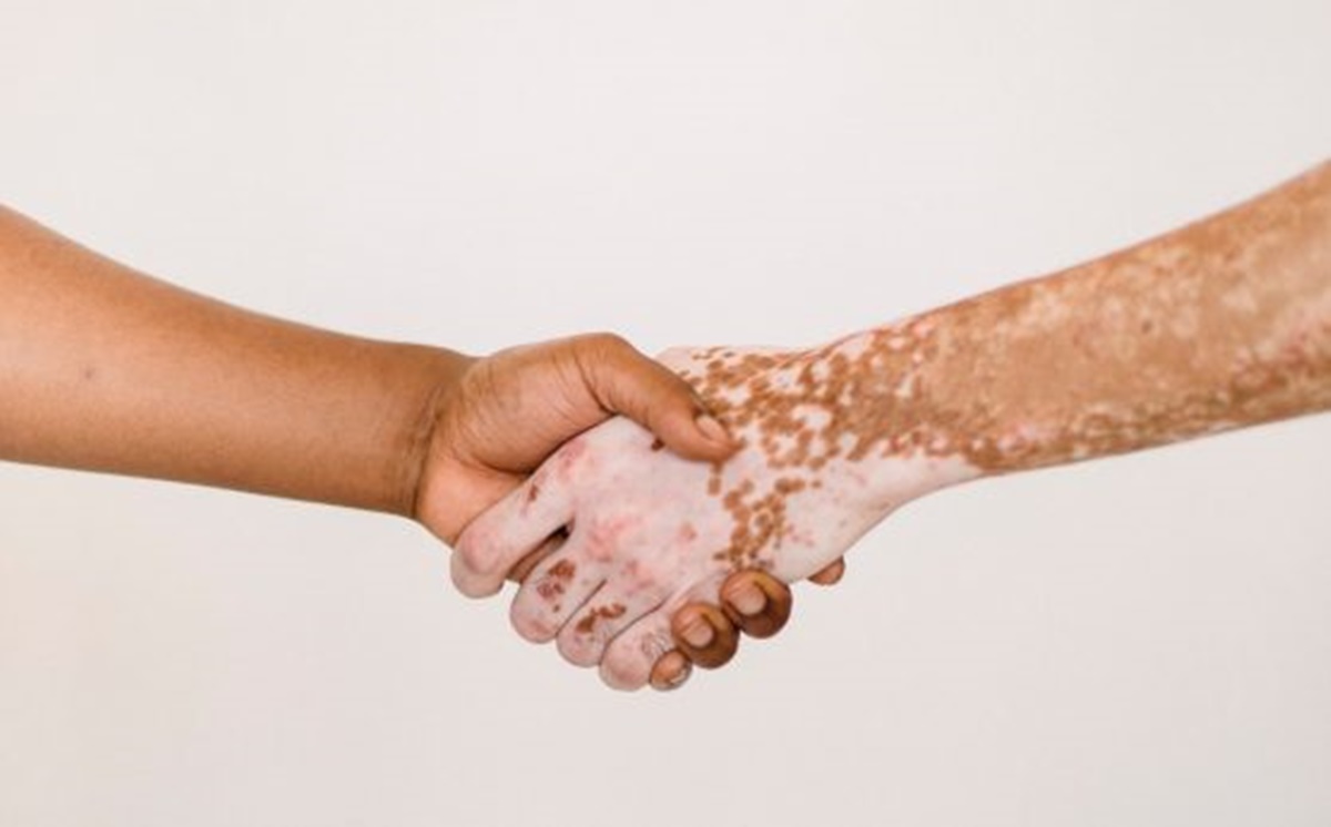 Covid vaccination and vitiligo