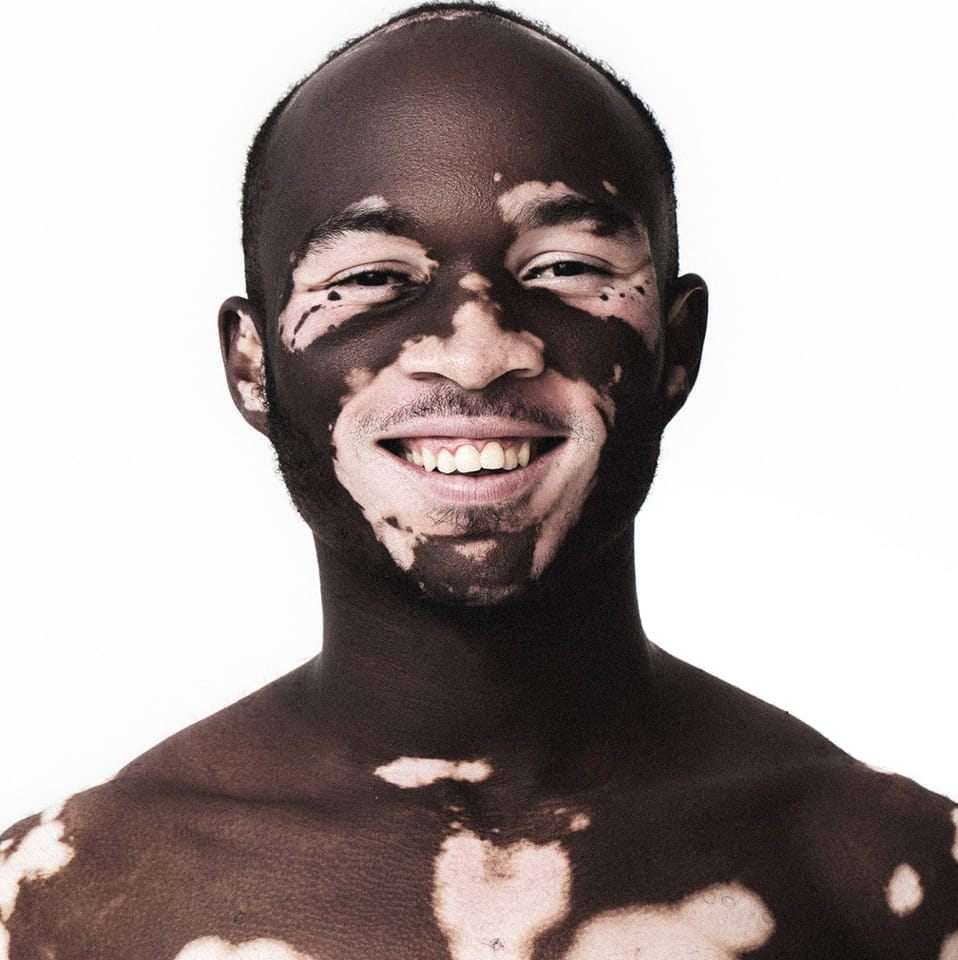 Vitiligo-Ghana-Foundation_vipoc.jpg