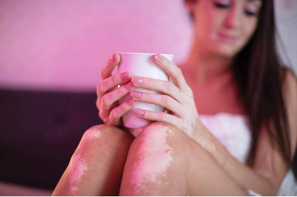 vitiligo_ukr_vipoc.jpg