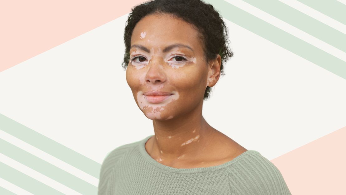 new research vitiligo cure