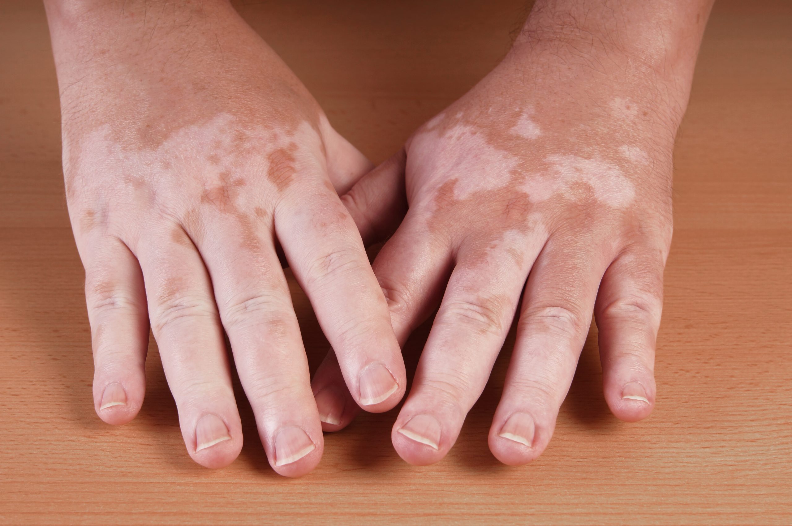 5 Facts You Didn’t Know About Vitiligo