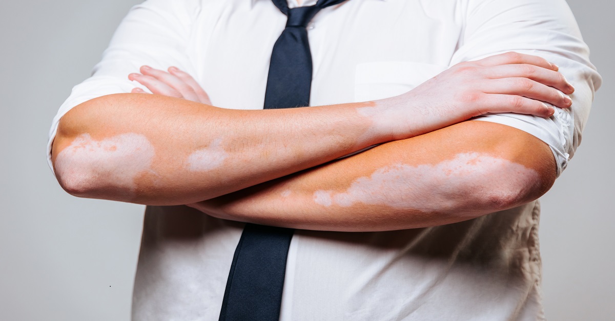 Current Status of Cell-Based Therapies for Vitiligo
