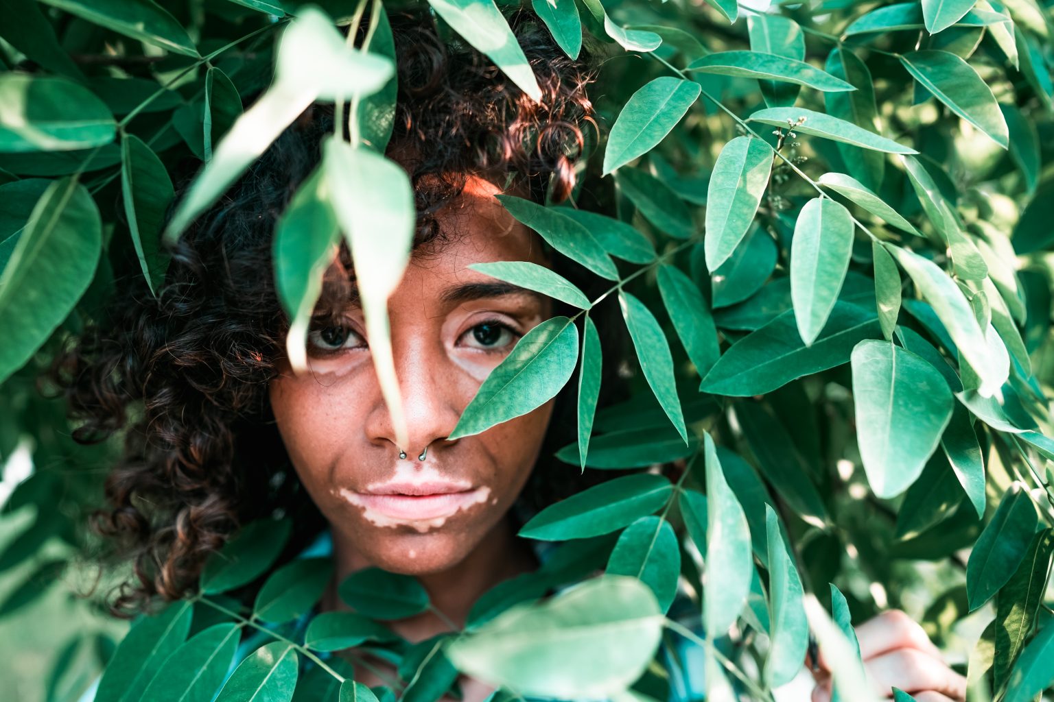 The History of Vitiligo Treatments VIPOC