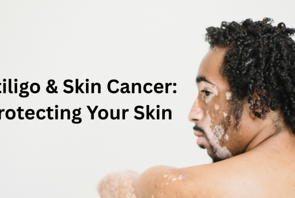 Vitiligo & Skin cancer