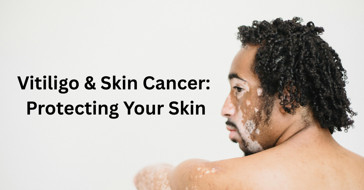 Vitiligo & Skin cancer